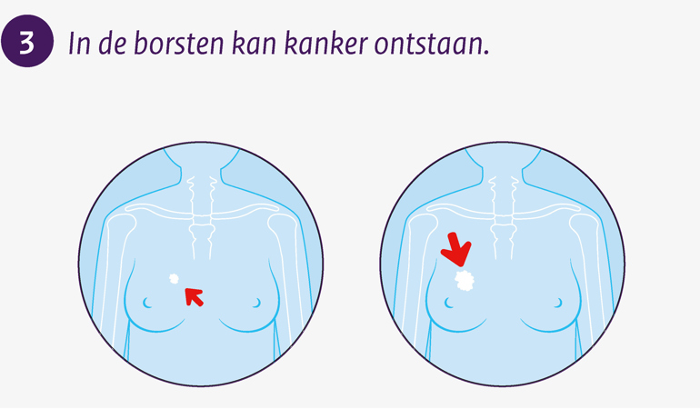 In de borsten kan kanker ontstaan.