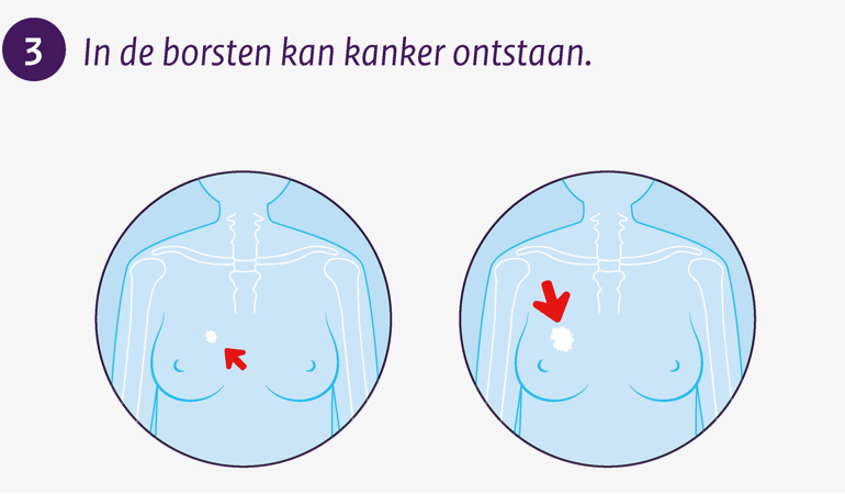 In de borsten kan kanker ontstaan.