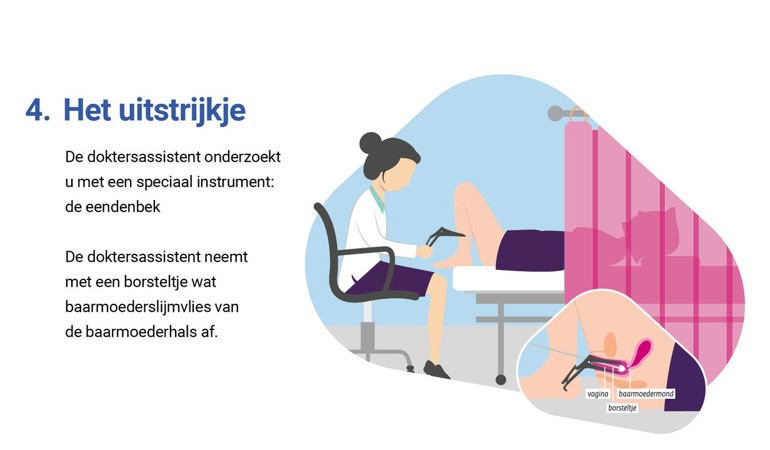 De doktersassistent onderzoekt u met een speciaal instrument: de eendenbek. De doktersassistent neemt met een borsteltje wat baarmoederslijmvlies van de baarmoederhals af.