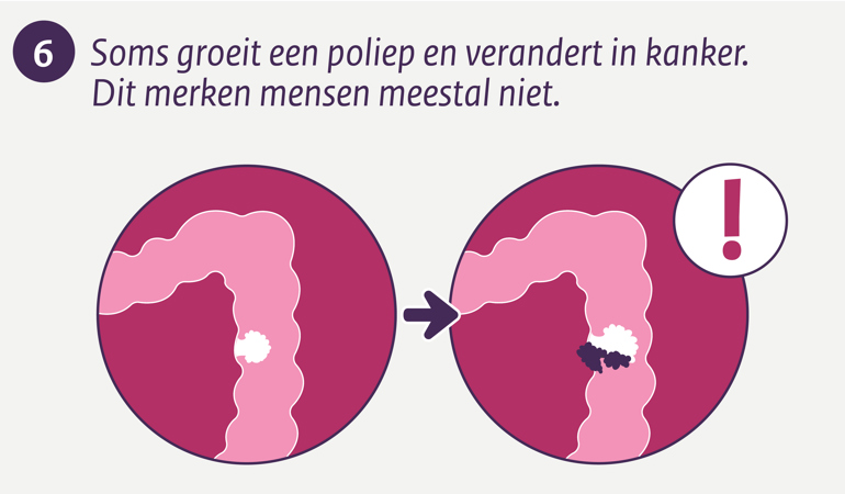 Soms groeit een poliep en verandert in kanker. Dit merken mensen meestal niet.