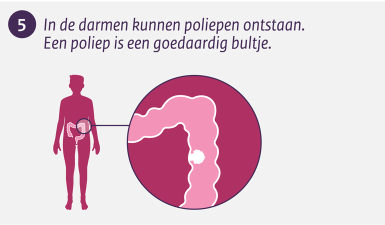 In de darmen kunnen poliepen ontstaan. Een poliep is een goedaardig bultje.